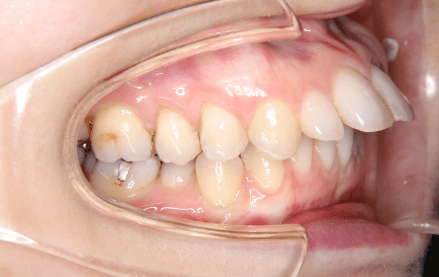 マウスピース矯正で上顎前突 出っ歯 を治した治療例 対応症例について 東京都中央区でマウスピース矯正 インビザライン をお探しなら日本橋駅すぐ エムアンドアソシエイツ矯正歯科