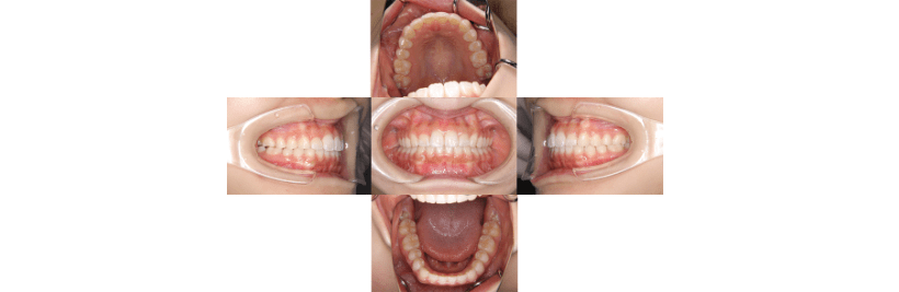 叢生 16歳 治療期間2年 症例と治療例 東京都中央区でマウスピース矯正 インビザライン をお探しなら日本橋駅すぐ エムアンドアソシエイツ矯正 歯科