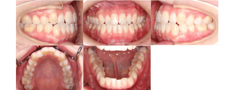 部分矯正01 28歳 治療期間10ヶ月 症例と治療例 東京都中央区でマウスピース矯正 インビザライン をお探しなら日本橋駅すぐ エムアンドアソシエイツ矯正歯科