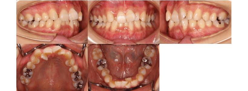 叢生 抜歯 25歳 治療期間2年 症例と治療例 東京都中央区でマウスピース矯正 インビザライン をお探しなら日本橋駅すぐ エムアンドアソシエイツ矯正歯科