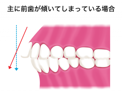 マウスピース矯正で上顎前突 出っ歯 を治した治療例 対応症例について 東京都中央区でマウスピース矯正 インビザライン をお探しなら日本橋駅すぐ エムアンドアソシエイツ矯正歯科