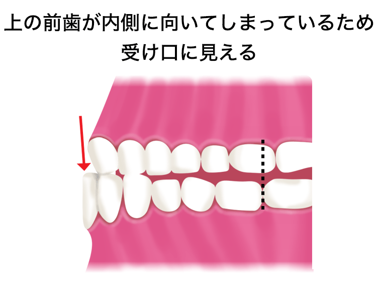 下顎前突 受け口 マウスピース型カスタムメイド装置 インビザライン 症例 対応症例について 東京都中央区でマウスピース矯正 インビザライン をお探しなら日本橋駅すぐ エムアンドアソシエイツ矯正歯科