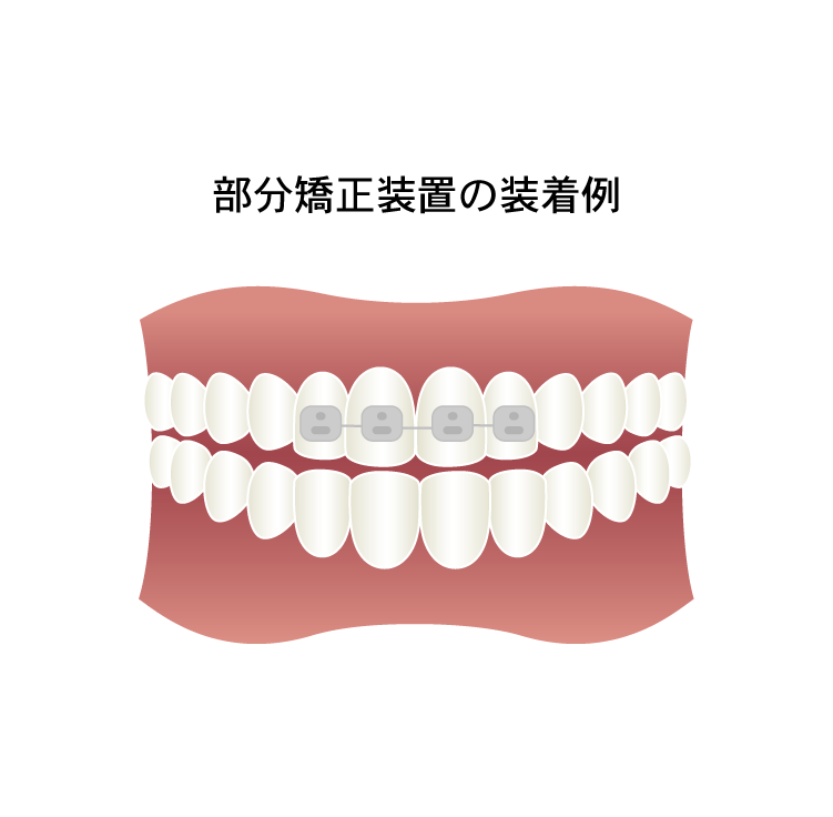 ワイヤーによる部分矯正 その他 矯正装置との比較 東京都中央区でマウスピース矯正 インビザライン をお探しなら日本橋駅すぐ エムアンドアソシエイツ矯正歯科