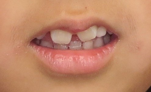 年齢別に矯正治療を知る 矯正治療について知る 東京都中央区でマウスピース矯正 インビザライン をお探しなら日本橋駅すぐ エムアンドアソシエイツ 矯正歯科