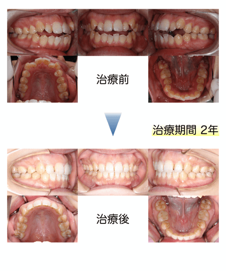 ガタガタの八重歯は抜くor残す 気になる判断基準と矯正方法 歯列矯正の基礎知識コラム 東京都中央区でマウスピース矯正 インビザライン をお探しなら日本橋駅すぐ エムアンドアソシエイツ矯正歯科