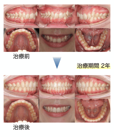 深い噛み合わせの過蓋咬合 矯正でどこまで治せる 歯列矯正の基礎知識コラム 東京 エムアンドアソシエイツ矯正歯科