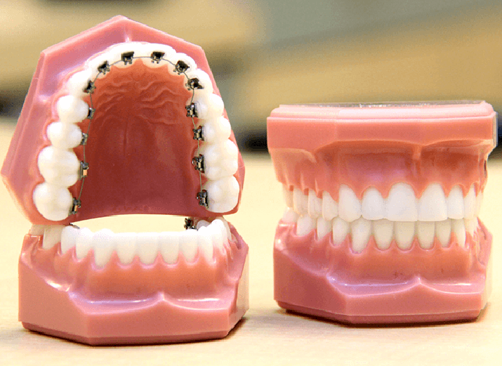 舌側矯正のメリット デメリットは何か 様々なポイントをご紹介 歯列矯正の基礎知識コラム 東京 エムアンドアソシエイツ矯正歯科