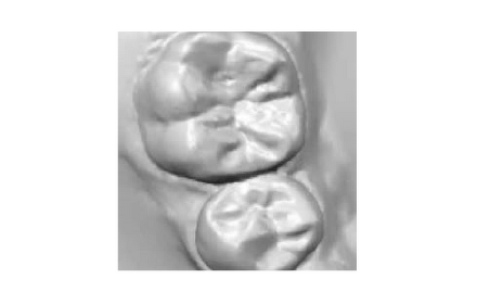 アイテロによる歯型取り