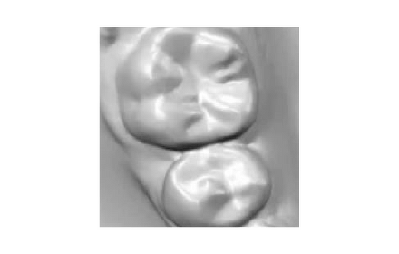 シリコンによる歯型取り