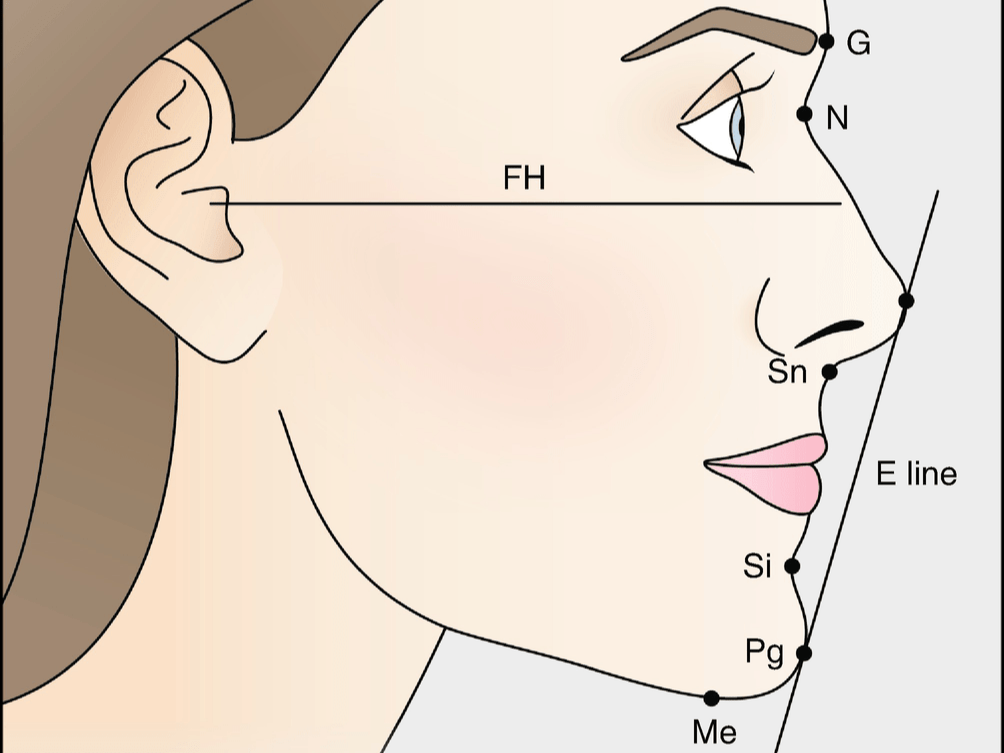 歯列矯正後の横顔の変化を比較 きれいなeラインを実現した症例 歯列矯正の基礎知識コラム 東京 エムアンドアソシエイツ矯正歯科
