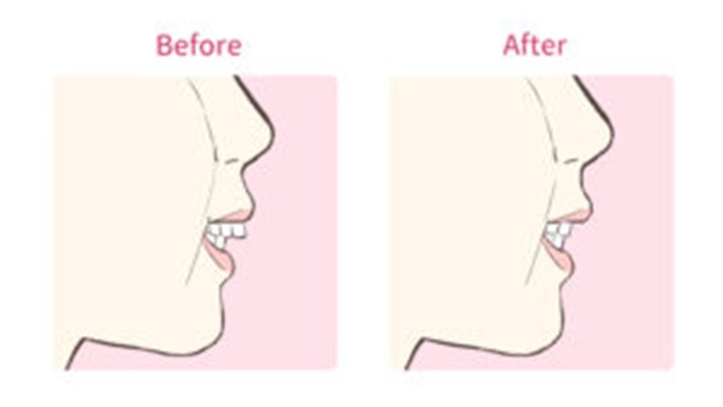歯列矯正後の横顔の変化を比較 きれいなeラインを実現した症例 歯列矯正の基礎知識コラム 東京 エムアンドアソシエイツ矯正歯科