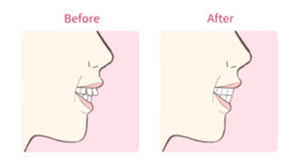歯列矯正後の横顔の変化を比較 きれいなeラインを実現した症例 歯列矯正の基礎知識コラム 東京 エムアンドアソシエイツ矯正歯科