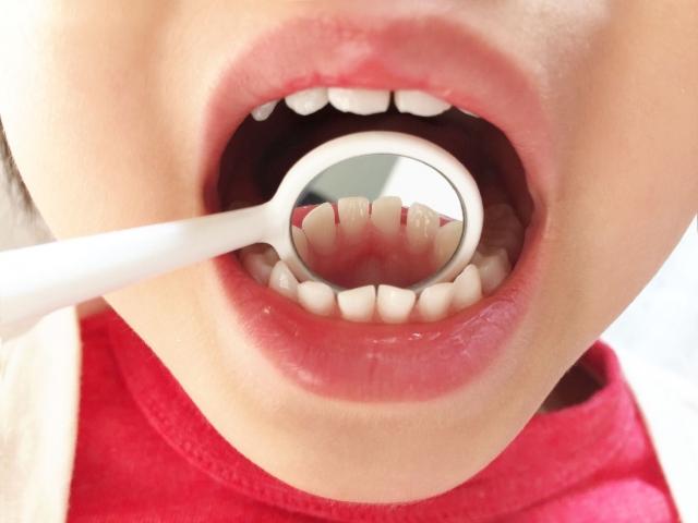 歯科用ミラーで子どもの歯の裏をチェックしている写真