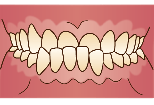 上下の歯が反対に噛み合っているイラスト