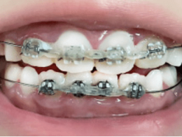 ワイヤー矯正をしている口元