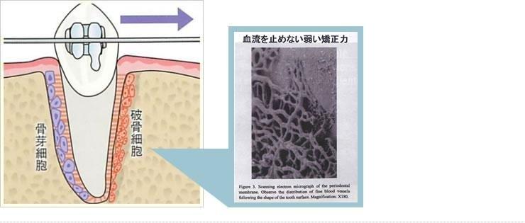 矯正力が加わった歯の断面図