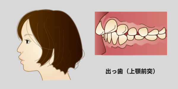出っ歯の女性の横顔と口のイラスト