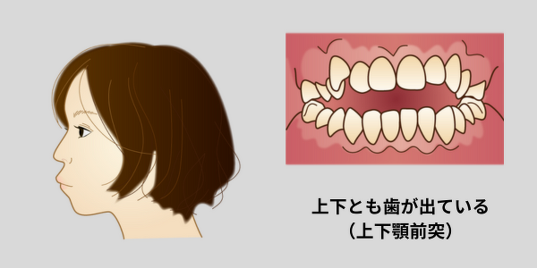 上下顎前突の女性の横顔と口のイラスト