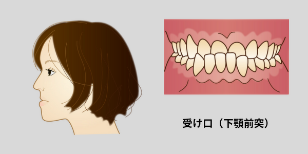 受け口の女性の横顔と口のイラスト