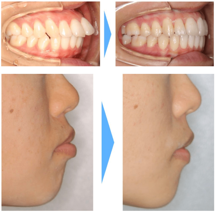 非抜歯の場合の症例写真