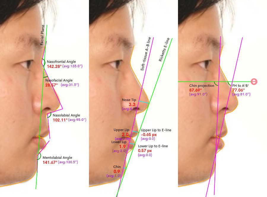 横顔の三パターンのシミュレーション画像