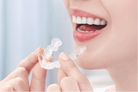 マウスピースを嵌めようとする女性の口元