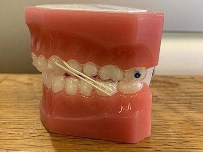 出っ歯矯正には顎間ゴムかけが効果大！そのやり方と注意点を解説