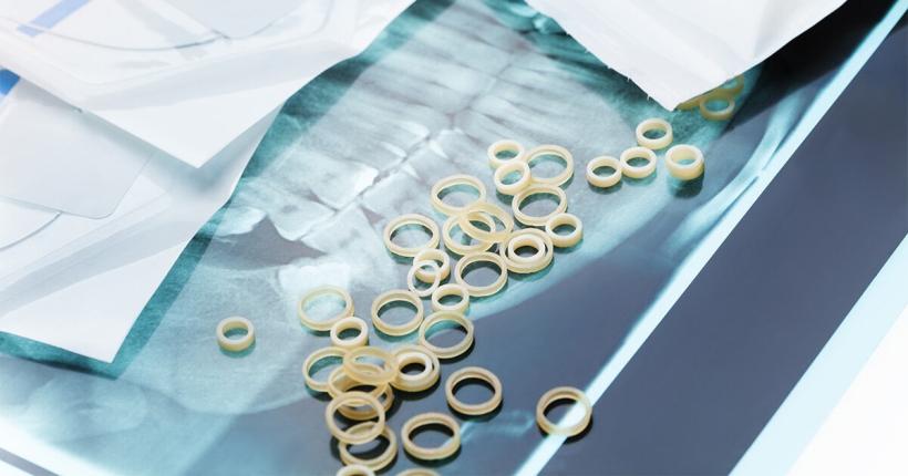 歯列矯正に使用するゴム