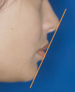 横顔のEライン（鼻先から顎先を結ぶ直線を引いた図）