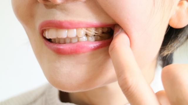 マウスピースにゴムを付けている口元