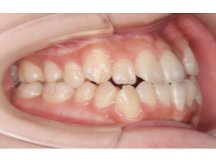 受け口の症例写真