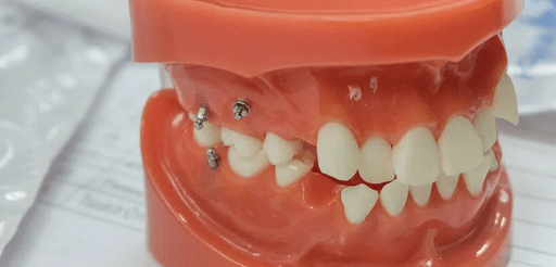 ガミースマイル・口ゴボにはアンカースクリュー矯正が有効？メリットと