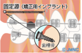 インプラント矯正