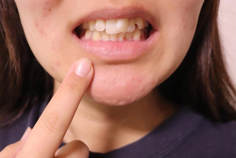 前歯が捻じれている口元