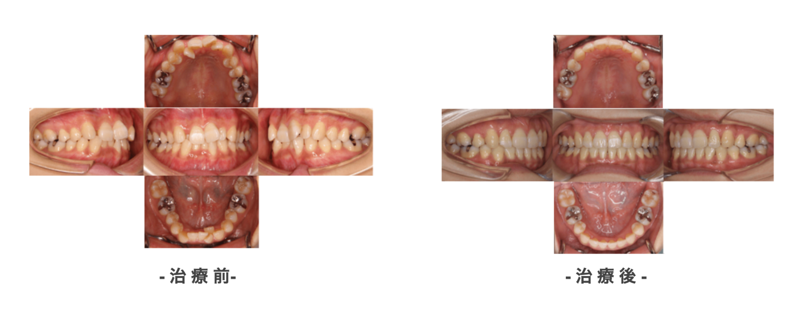 症例１治療前後