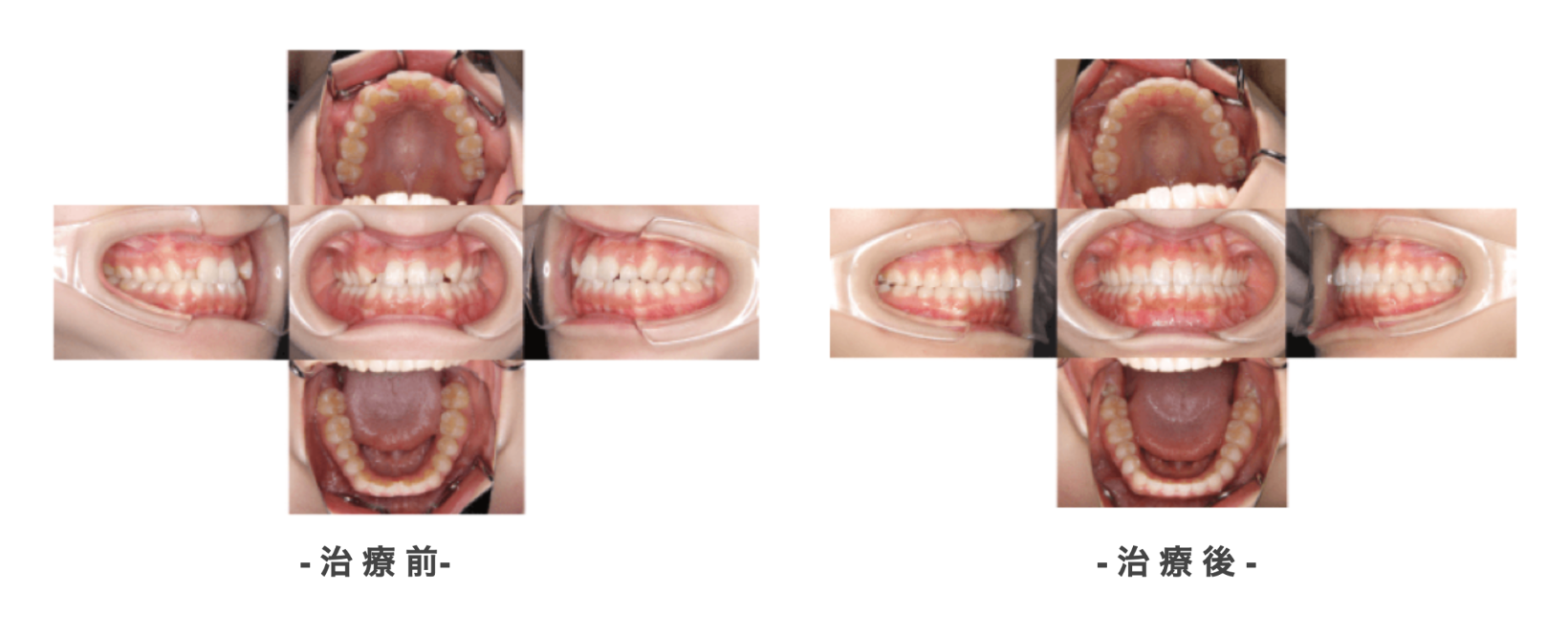 症例２治療前後