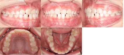矯正治療前の口腔内写真