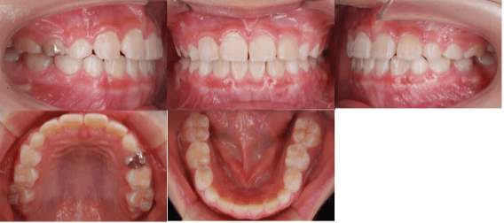 矯正治療後の口腔内写真